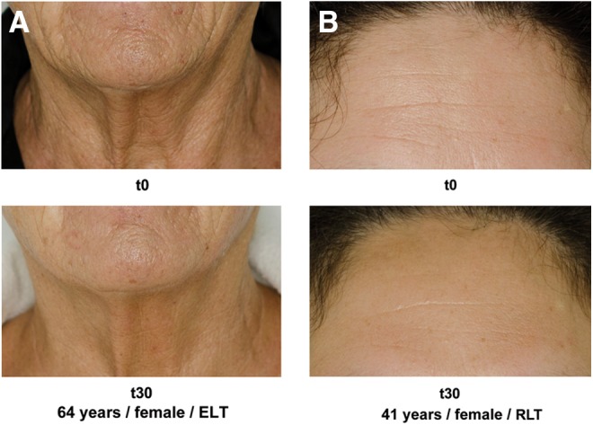 resultats phototherapie rajeunissement peau