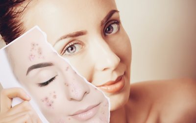 La photothérapie : un traitement efficace contre l’acné